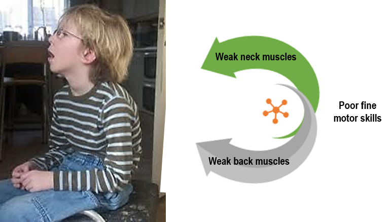 This picture shows a boy who is sitting and looking at something in a classroom.  He has weak back, neck, and facial muscles shown by his rounded back and open mouth